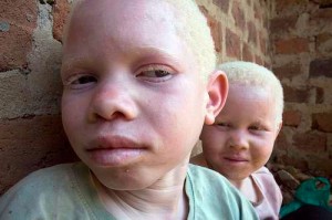 En Tanzanie, où les croyances sur les pouvoirs magiques dus à l’albinisme persistent, meurtres et mutilations se sont intensifiées.