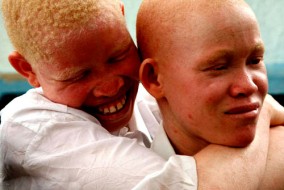 On estime que plus de 150.000 albinos vivent en Tanzanie; un certain nombre d'albinos ont fui vers la région de Dar es Salaam (Maison de la Paix ou Havre de Paix) la plus grande ville de Tanzanie, parce qu’ils se sentent plus en sécurité dans un milieu urbain. On pense que la Tanzanie possède la plus grande population d'albinos en Afrique.